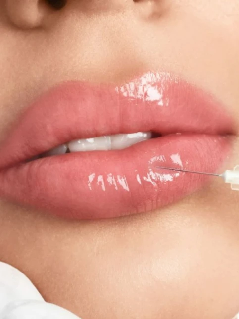 Preenchimento Labial Preenchimento Labial