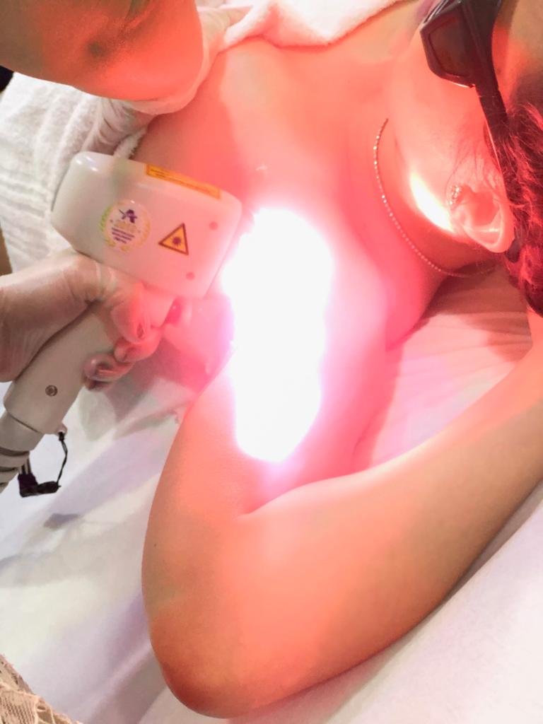 Depilação a laser axila feminina no Tatuapé