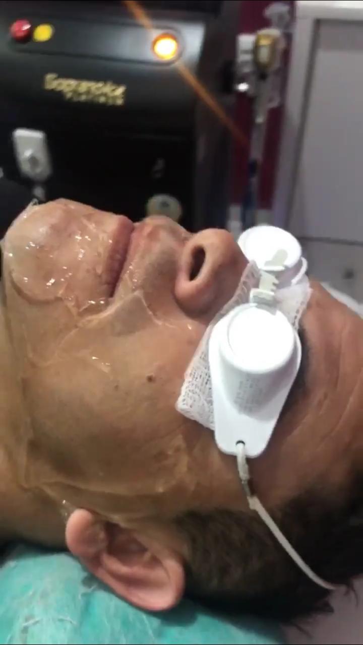 Depilação a laser barba completa no Tatuapé