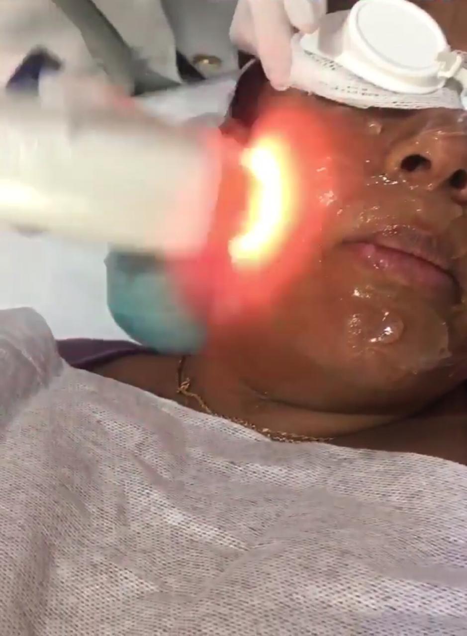 Depilação a laser facial no Tatuapé