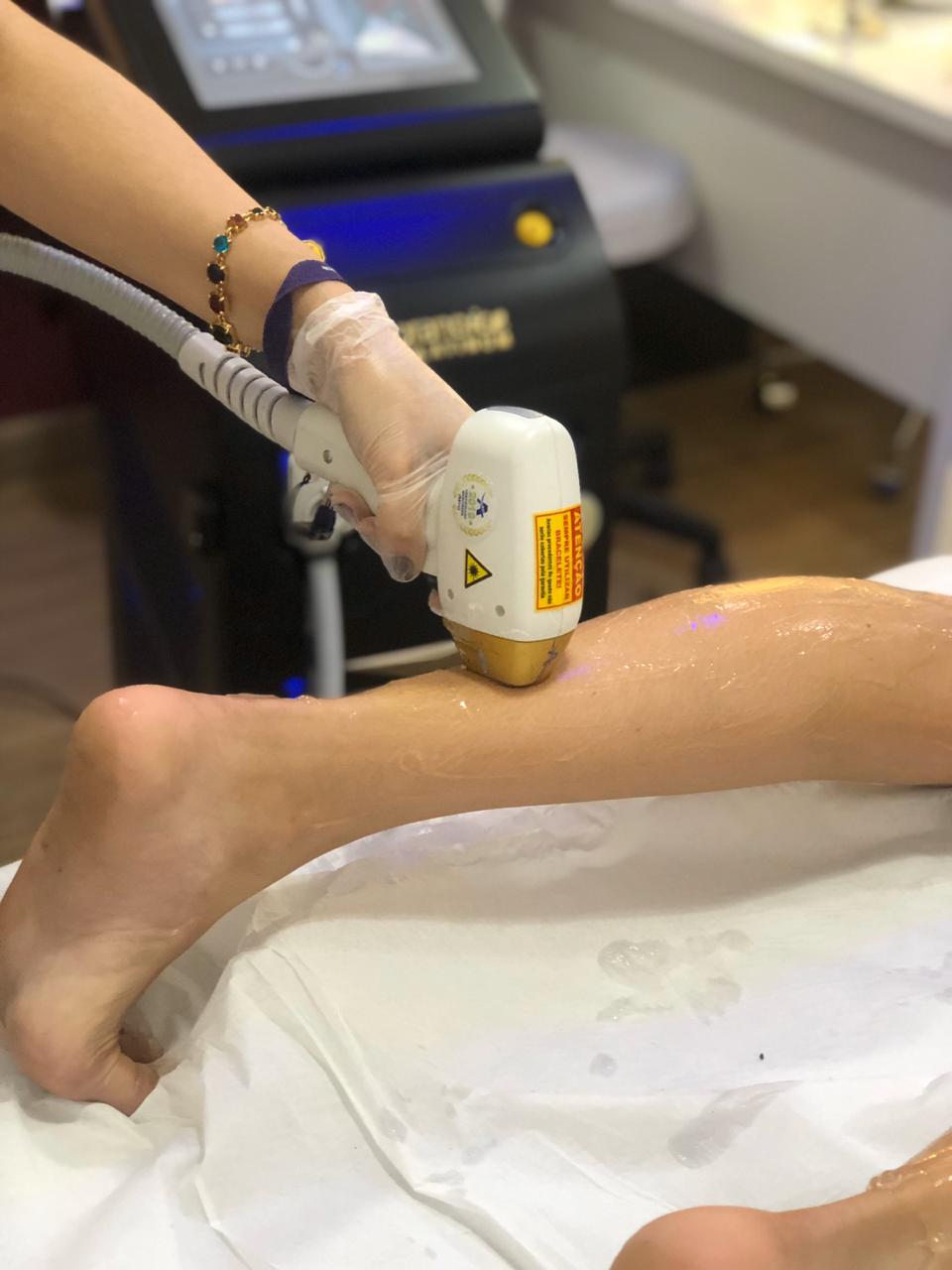 Depilação a laser perna completa Santana