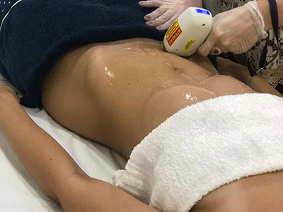 Depilação a laser abdomen no Tatuapé da Danielle Oliveira