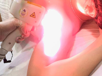 Depilação a laser axila feminina no Tatuapé da Danielle Oliveira