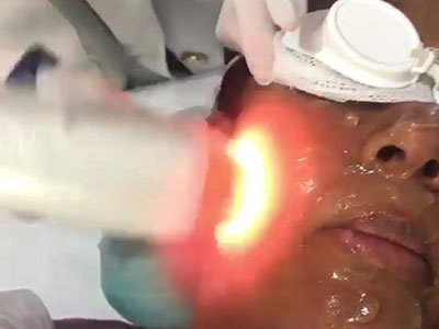 Depilação a laser facial na Zona Leste da Danielle Oliveira