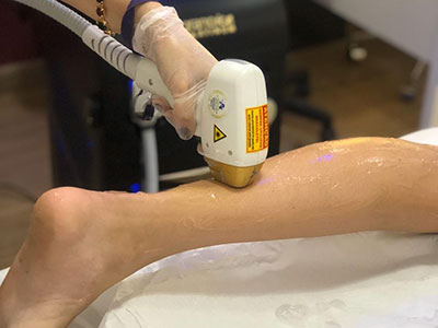 Depilação a laser meia perna no Tatuapé da Danielle Oliveira